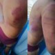 Trabalhador é brutalmente agredido por 'piratas dos rios' em Jutaí